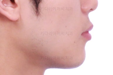 연산동치아교정