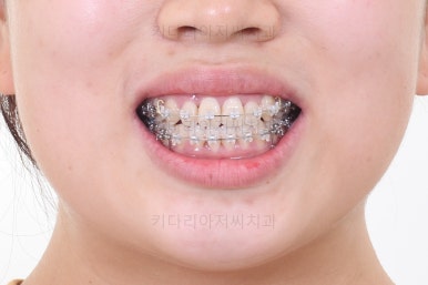 부산비발치교정