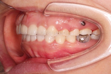 부산구순구개열