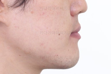 부산비수술교정