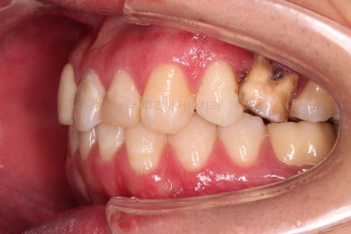 연산동치아교정