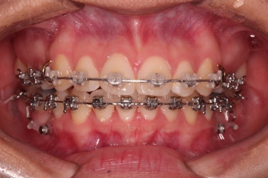 연산동치아교정치과