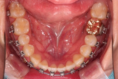 부산치아교정잘하는곳