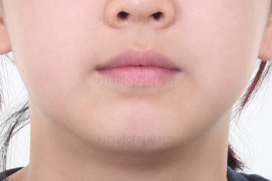 부산토끼치아교정