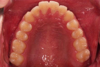 부산주걱턱교정