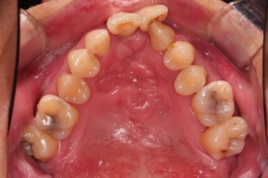 부산구순구개열교정