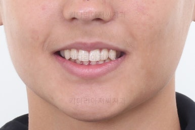 부산연산동치아교정