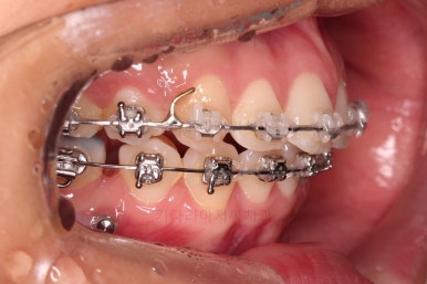 연산동치아교정치과