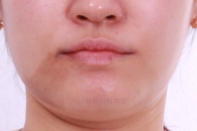 부산치아교정잘하는곳