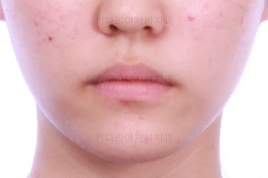 부산비발치교정