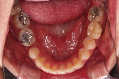 연산동치아교정