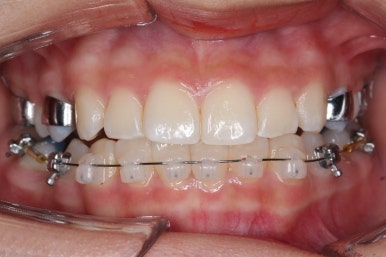 부산치아교정잘하는곳