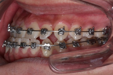 부산주걱턱교정