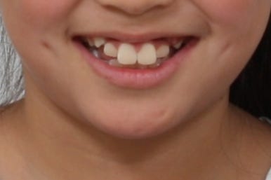 연산동덧니교정