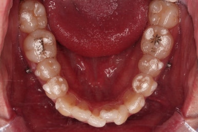 부산인비절라인