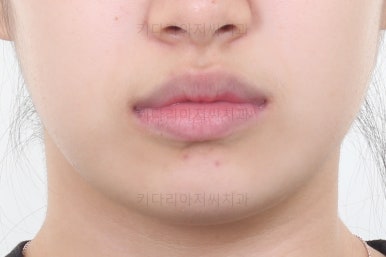 부산치아교정