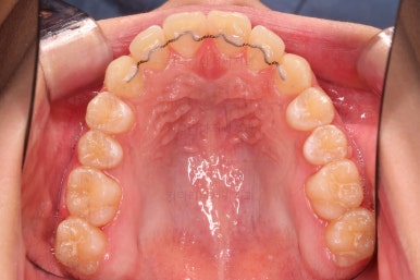 부산비발치교정