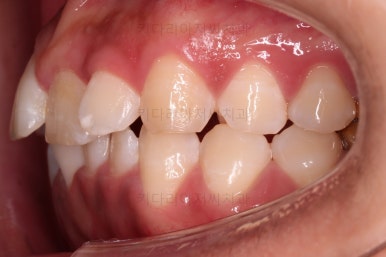 부산안면비대칭