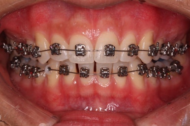 부산연산동치아교정