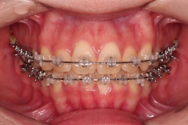 부산비발치교정