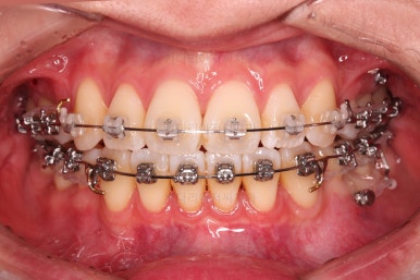 부산치아교정잘하는치과