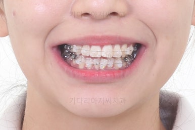 부산사랑니교정