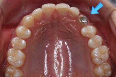 부산매복치아교정