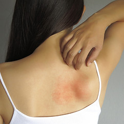 Health allergy skin care problem. Closeup young woman scratching her itchy back with aller