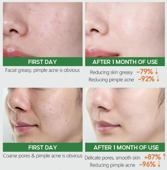 תמונה ממוזערת: טונר וסרום טיפולי לטיפול בצלקות אקנה ובקמטים - VIBRANT GLAMOUR