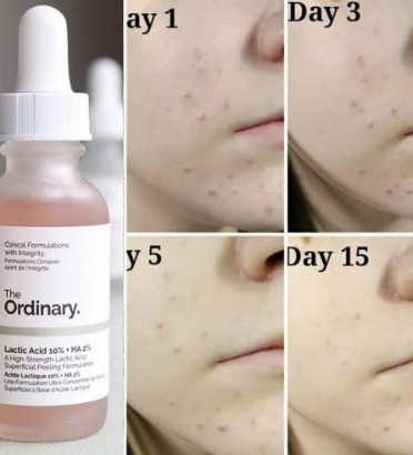 תמונה ממוזערת: סרום חומצה לקטית 5% | סרום לפנים | THE Ordinary | חומצה לקטית