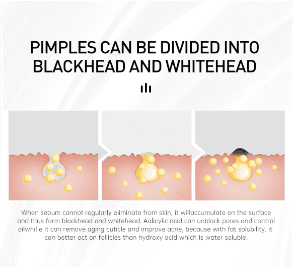 תמונה ממוזערת: טיפול באקנה | חומצה סליצילית | קרם לעור שמ | AuQuest - קרם לאקנה