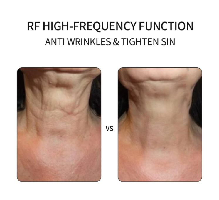 Thumbnail: מכשיר אנטי אייג'ינג ביתי מומלץ | מיצוק עור הפנים | אנטי אייג'ינג