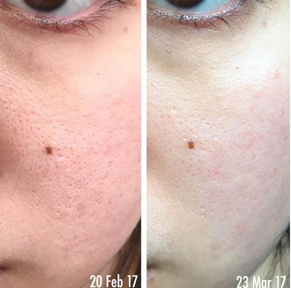 תמונה ממוזערת: טונר לפנים | טיפול באקנה | PIXI | טונר חומצה גליקולית