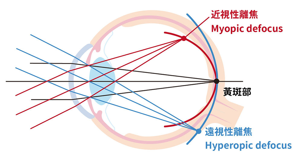 周邊離焦重點:周邊視網膜的成像位置,是影響眼軸增長的重要因素。