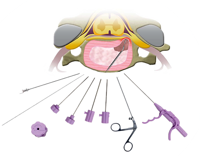 Micro_Discectomia_Percutânea_Cervical_-_