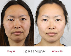 zriinew tightens skins and smooths