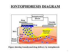 Iontophoresis Diagram