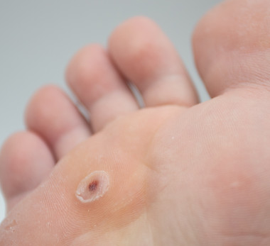 Toe wart. Foot with wart on a toe. Wart verrucas plantar..jpg
