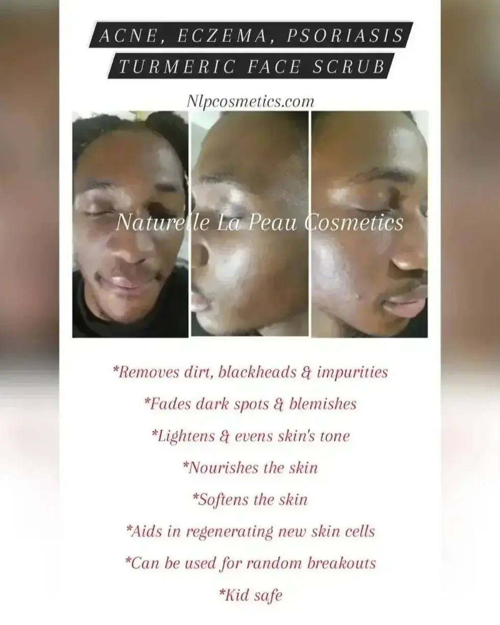 Thumbnail: Acne & Eczema Soap Bar