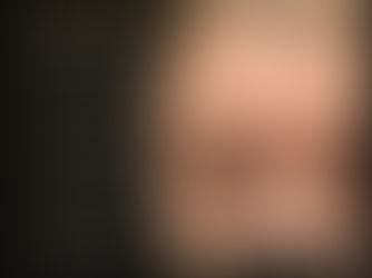 What Causes Forehead Wrinkles?