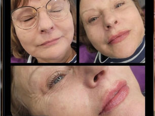 Lip Fillers in Stone, Staffordshire: What to Expect, How Much Filler You Need & Aftercare Advice