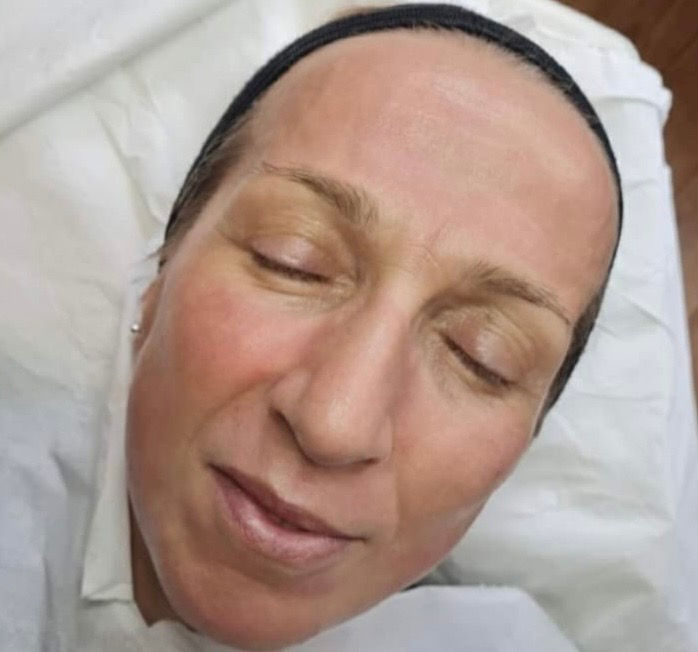 Cheek Filler Explained