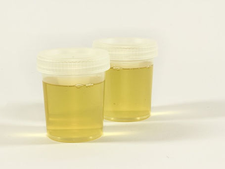 Uncomplicated UTI: Features and Findings