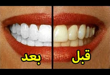 افضل طريقة لتبييض الاسنان -عفريت المعرفة
