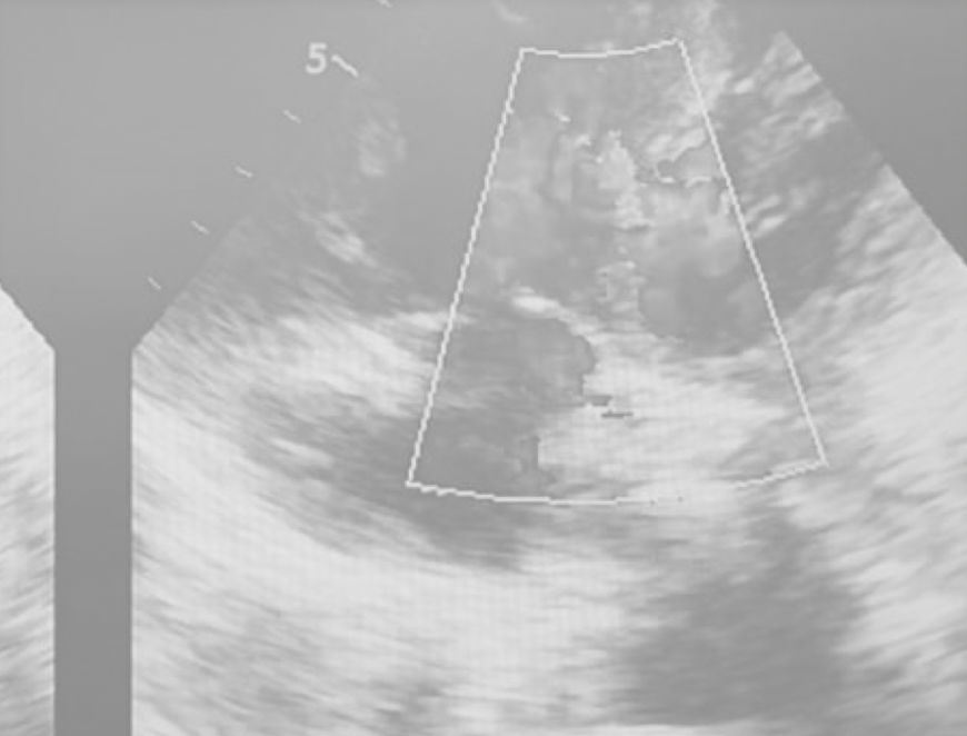 Anesthesia Management of Sectio Caesarian Patients with Eisenmenger