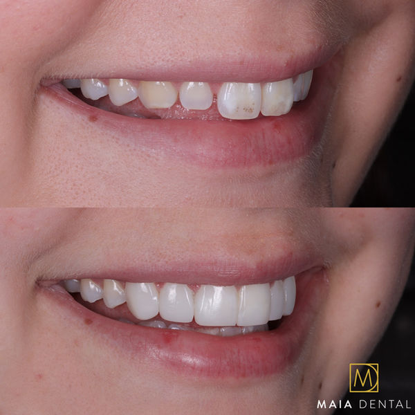 Maia dental, Rothwell, Leeds, smile created with Enlighten whitening and composite bonding