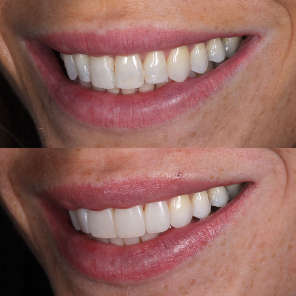 Maia dental, Rothwell, Leeds, smile created with  composite bonding
