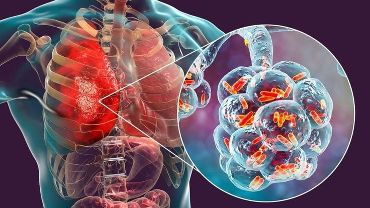 Pneumonia: Causes, Symptoms, Treatment, and Prevention