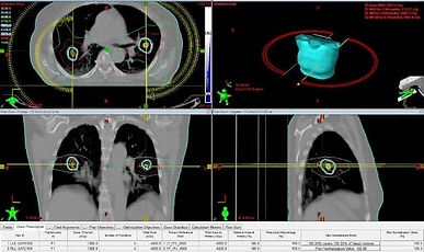 Lung SABR Treatment
