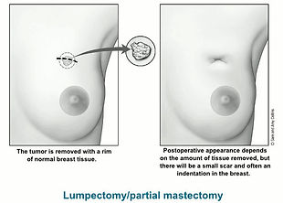 Breast Conservation Therapy